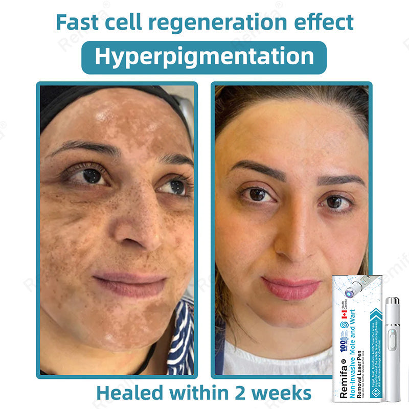 🇨🇦Remifa® Non-invasive Mole & Wart Removal Laser Pen(Quick and painless removal of warts, moles, age spots, and skin tags with no side effects)🔥
