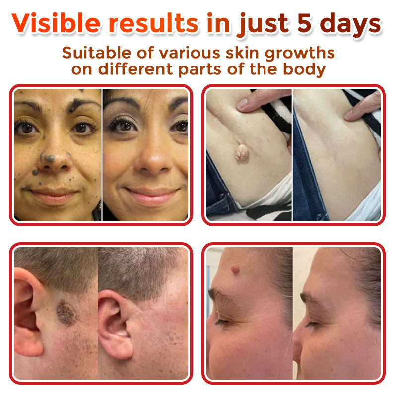 🇨🇦❤️🔥GFOUK® MicroNeedle Botanic Skin Tag Removal Patch 🇺🇸 Made in the USA