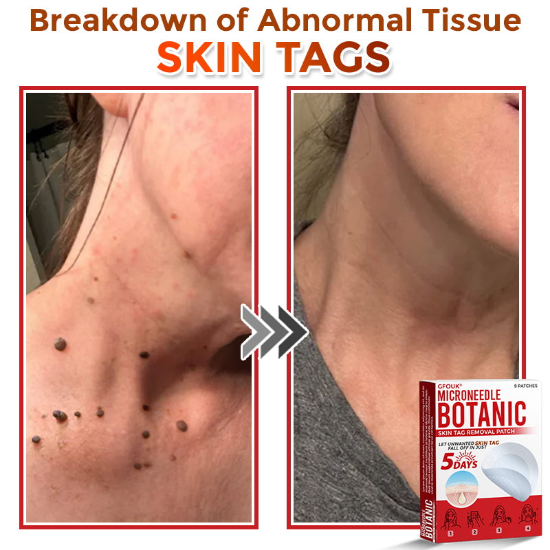 🇨🇦❤️🔥GFOUK® MicroNeedle Botanic Skin Tag Removal Patch 🇺🇸 Made in the USA