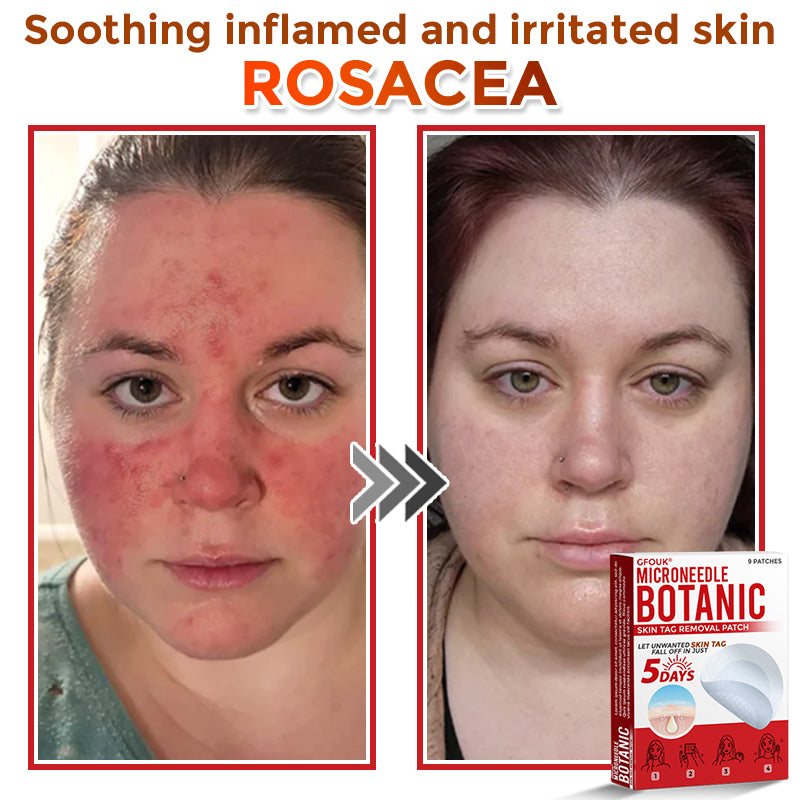 🇨🇦❤️🔥GFOUK® MicroNeedle Botanic Skin Tag Removal Patch 🇺🇸 Made in the USA