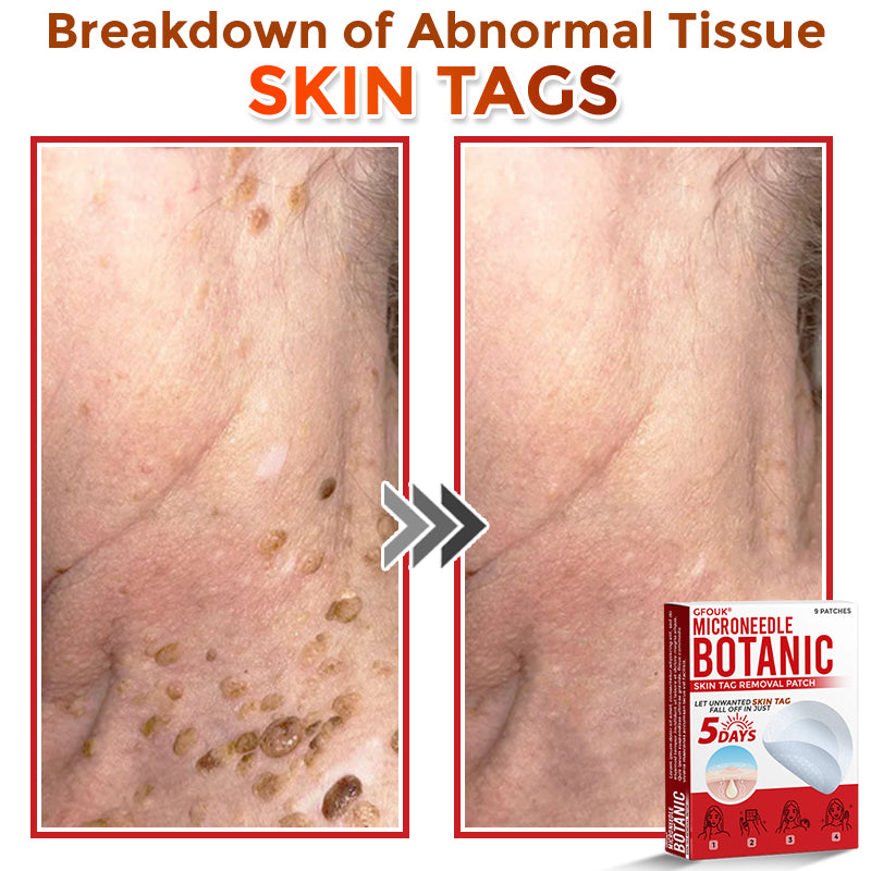 🇨🇦❤️🔥GFOUK® MicroNeedle Botanic Skin Tag Removal Patch 🇺🇸 Made in the USA