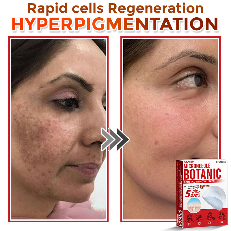 🇨🇦❤️🔥GFOUK® MicroNeedle Botanic Skin Tag Removal Patch 🇺🇸 Made in the USA