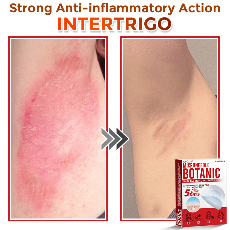 🇨🇦❤️🔥GFOUK® MicroNeedle Botanic Skin Tag Removal Patch 🇺🇸 Made in the USA