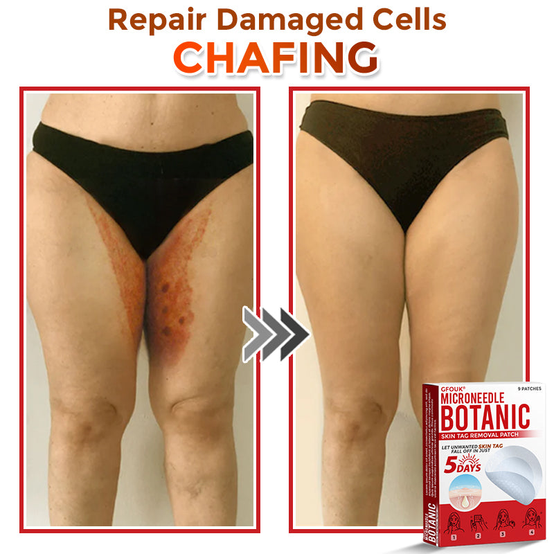 🇨🇦❤️🔥GFOUK® MicroNeedle Botanic Skin Tag Removal Patch 🇺🇸 Made in the USA