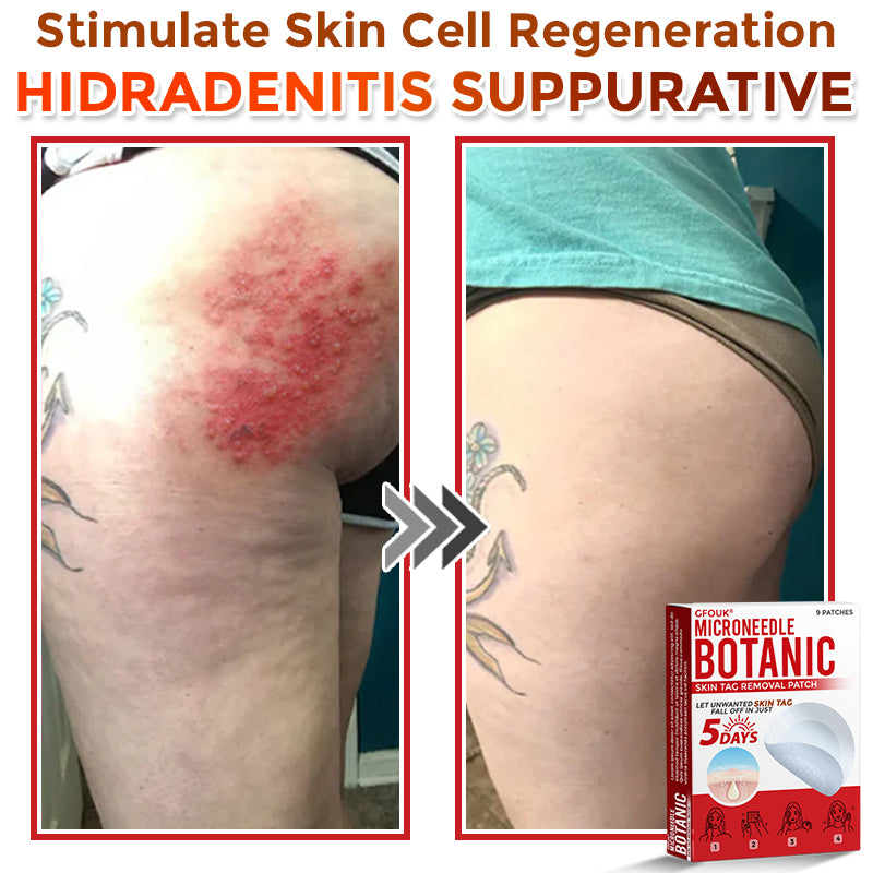 🇨🇦❤️🔥GFOUK® MicroNeedle Botanic Skin Tag Removal Patch 🇺🇸 Made in the USA
