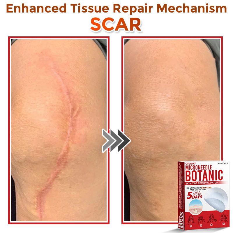 🇨🇦❤️🔥GFOUK® MicroNeedle Botanic Skin Tag Removal Patch 🇺🇸 Made in the USA