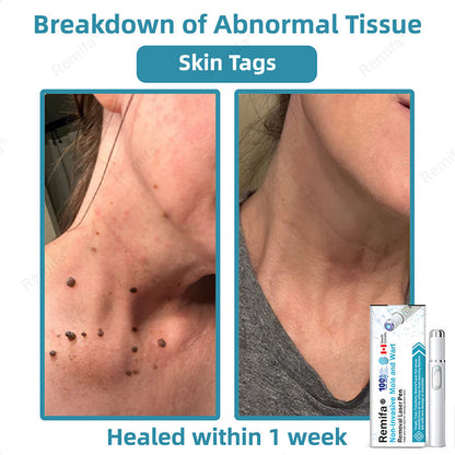🇨🇦✨Remifa® Non-invasive Mole & Wart Removal Laser Pen(Quick and painless removal of warts, moles, age spots, and skin tags with no side effects)🔥