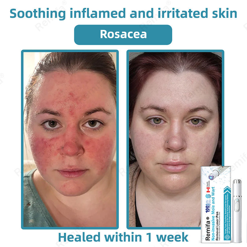 🇨🇦✨Remifa® Non-invasive Mole & Wart Removal Laser Pen(Quick and painless removal of warts, moles, age spots, and skin tags with no side effects)🔥