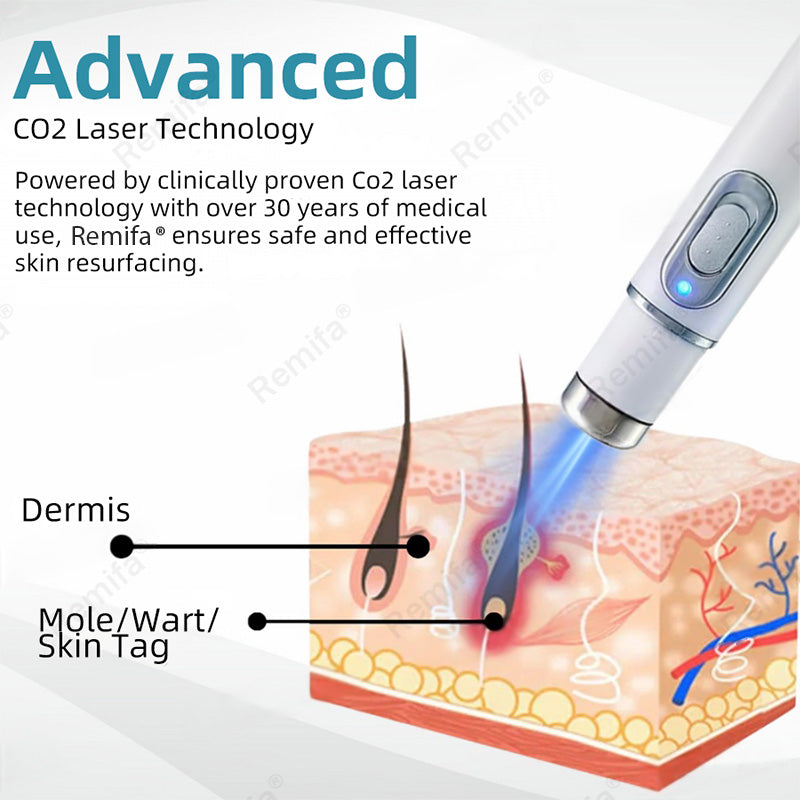 🇨🇦🌈Remifa® Non-invasive Mole & Wart Removal Laser Pen(Quick and painless removal of warts, moles, age spots, and skin tags with no side effects)🔥