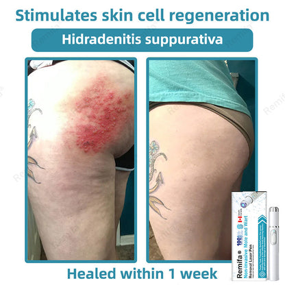 🇨🇦🌈Remifa® Non-invasive Mole & Wart Removal Laser Pen(Quick and painless removal of warts, moles, age spots, and skin tags with no side effects)🔥