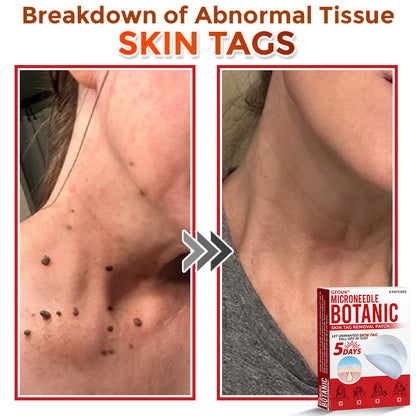🇨🇦❤️‍🔥GFOUK® MicroNeedle Botanic Skin Tag Removal Patch 🇺🇸 Made in the USA