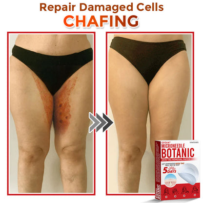 🇨🇦❤️‍🔥GFOUK® MicroNeedle Botanic Skin Tag Removal Patch 🇺🇸 Made in the USA