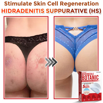 🇨🇦❤️‍🔥GFOUK® MicroNeedle Botanic Skin Tag Removal Patch 🇺🇸 Made in the USA